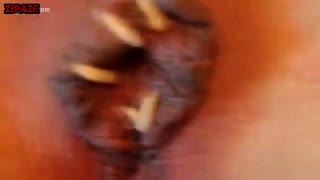 Аялдын кискасынан курттар, курттар жана башка сойлоп жүрүүчү сойлоп чыгат